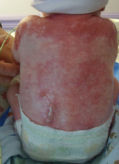 Patient with AEC syndrome (photo courtesy of Virginia Sybert)